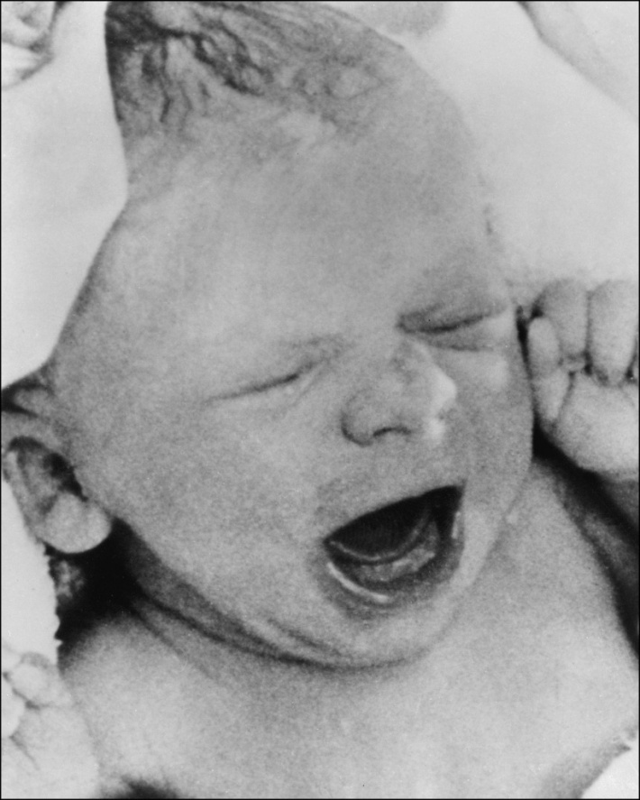 Louise Brown, primul bebelus creat in vitro, nascut la 25 iulie 1978, Foto: blog.chron.com