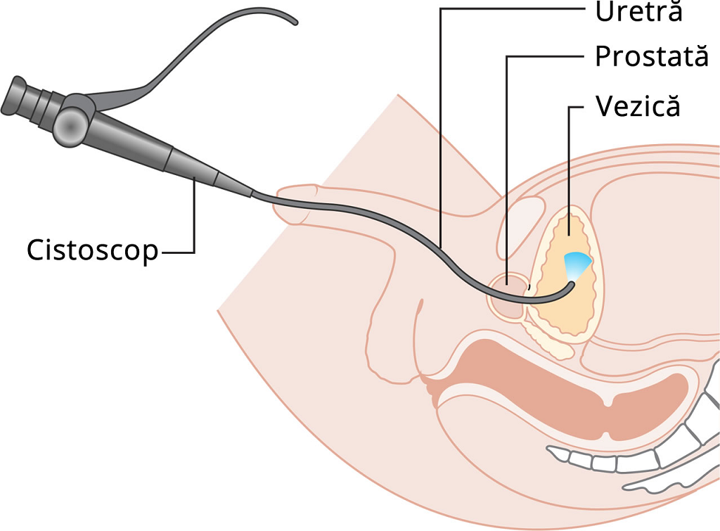 cistoscop
