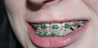 Proteza dentara de-a lungul timpului Aparat dentar