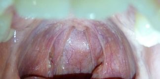 Este corect – Mă doare amigdalita/apendicita